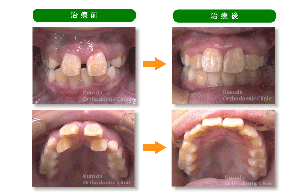混合歯列列期の矯正治療